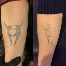 laser-tattoo-removal-HOM