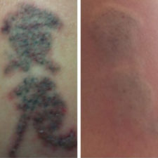 laser-tattoo-removal-HOM