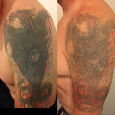 laser-tattoo-removal-HOM