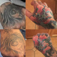 laser-tattoo-removal-HOM