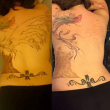 laser-tattoo-removal-HOM